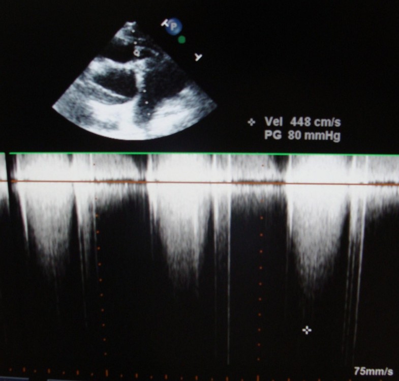 MRSA endocarditis of bovine Contegra valved conduit: a case report ...