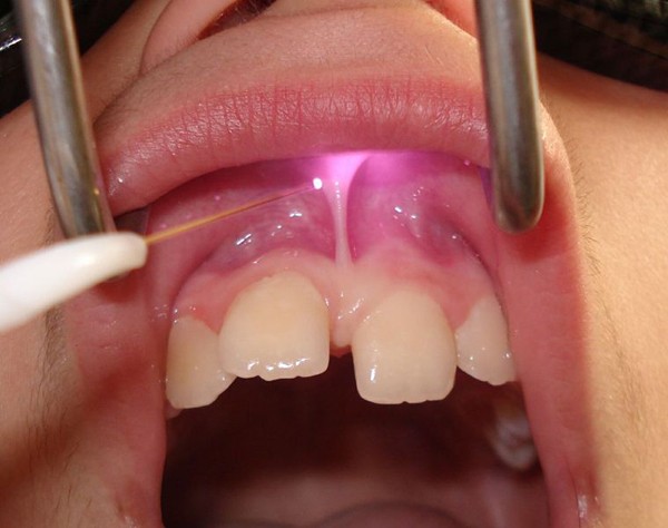 Upper Lip Laser Frenectomy Without Infiltrated Anaesthesia In A 