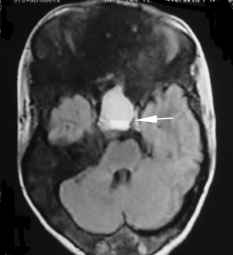 MR and CT findings of cyst degeneration of sphenoid bone in McCune