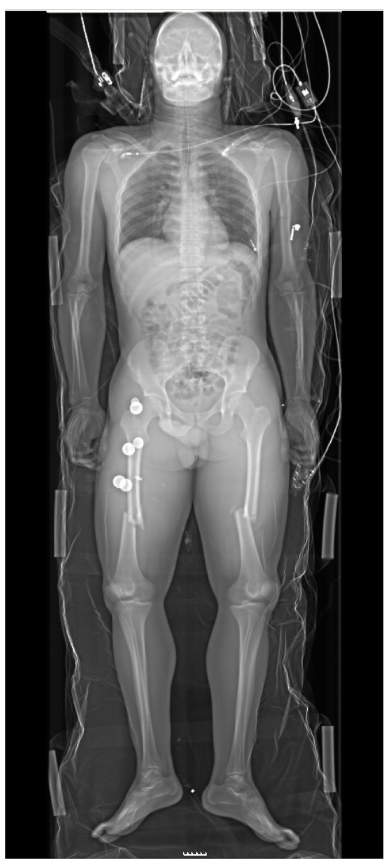 Personal experience with wholebody, lowdosage, digital Xray scanning