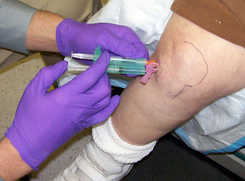anteriolateral injecting patella patellar tendon accurate ltp plunger aspirate 2555 1186 fluid