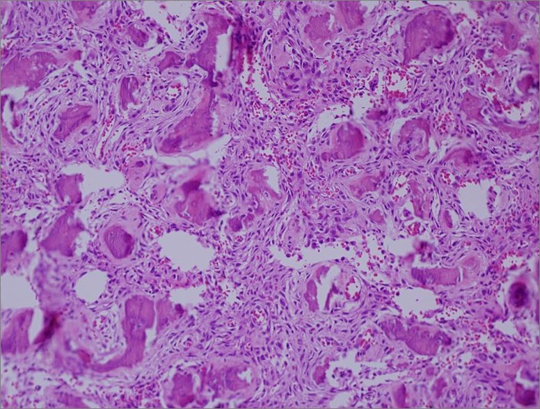 Fibrous dysplasia and aneurysmal bone cyst of the skull base presenting ...