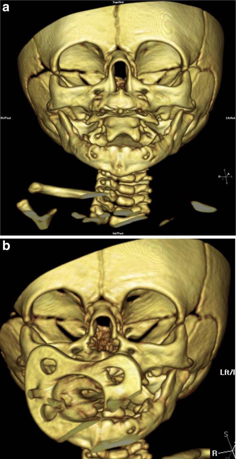Congenital nasal pyriform aperture stenosis: diagnosis and management