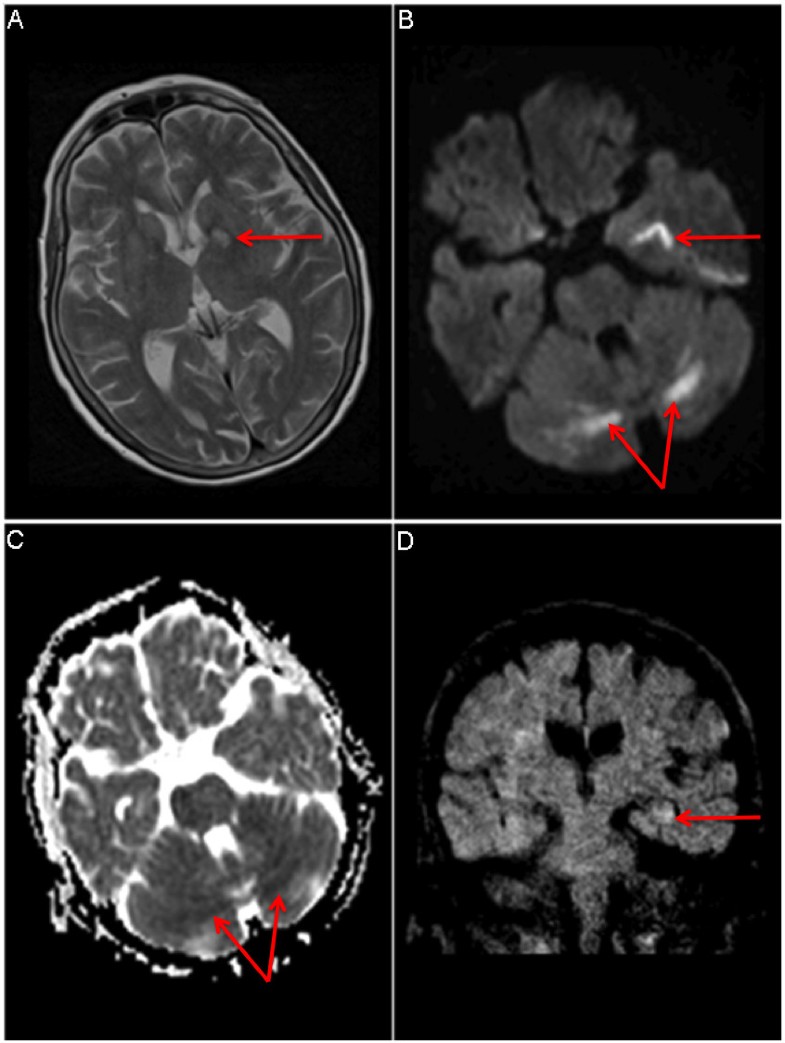 carbon dioxide poisoning on imaging carbon dioxide poisoning on imaging
