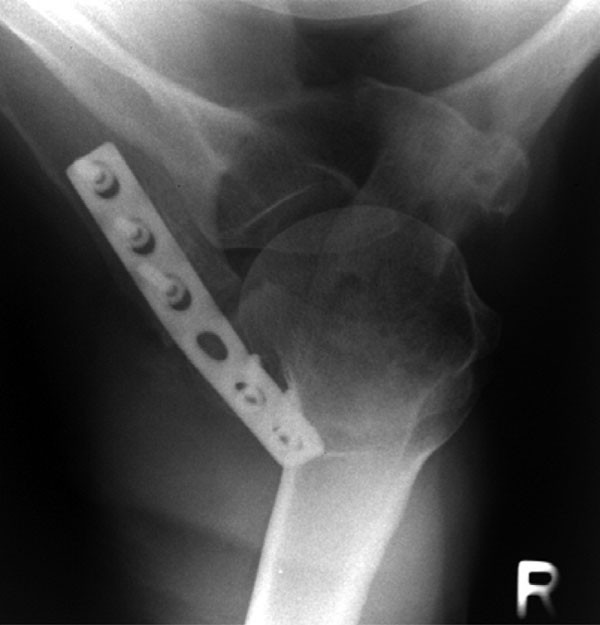 Midterm results after operative treatment of rockwood grade IIIV