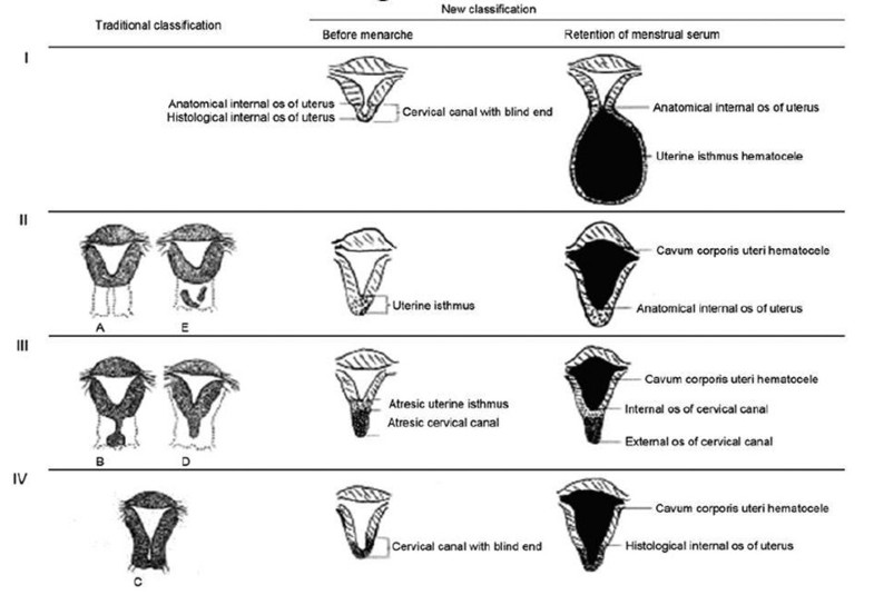 Clinical characteristics of congenital cervical atresia based on ...