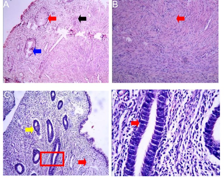 Clinical characteristics of congenital cervical atresia based on ...