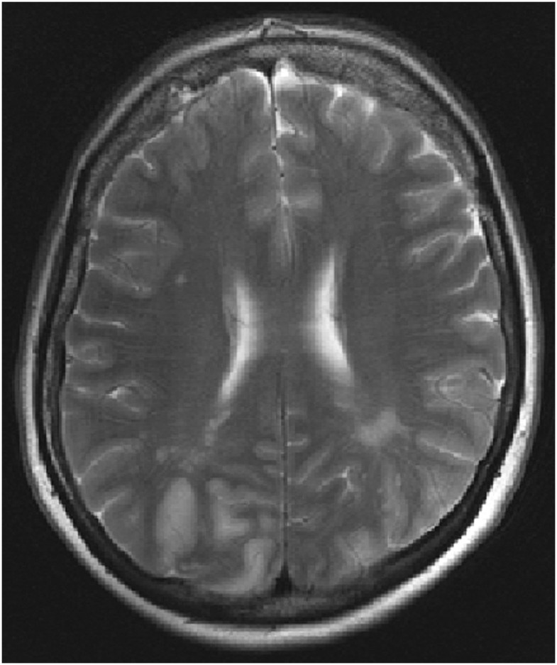 Hypertensive encephalopathy and cerebral infarction | SpringerPlus ...