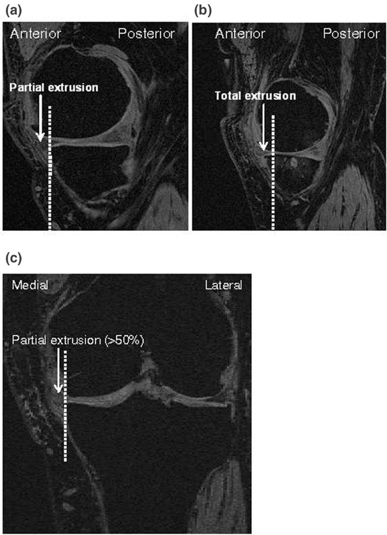 Knee meniscal extrusion in a largely nonosteoarthritic cohort