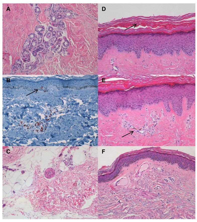 Histopathological Cutaneous Alterations In Systemic Sclerosis: A ...