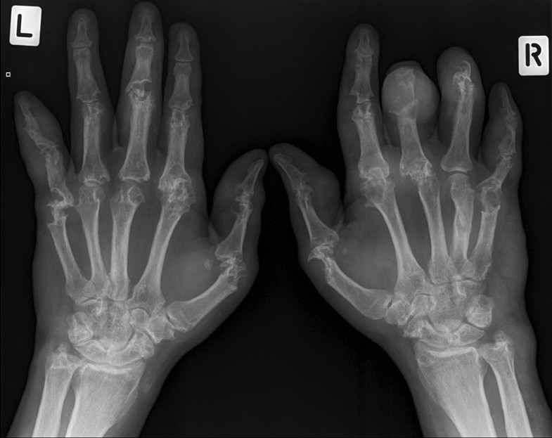 Imaging in gout What can we learn from MRI, CT, DECT and US
