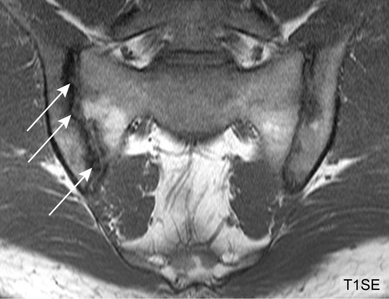 Can erosions on MRI of the sacroiliac joints be reliably