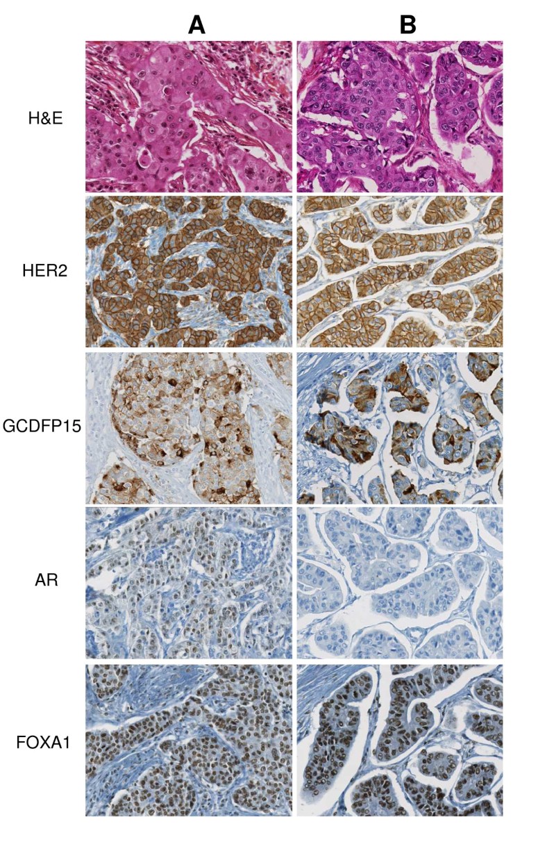 Molecular apocrine breast cancers are aggressive estrogen receptor