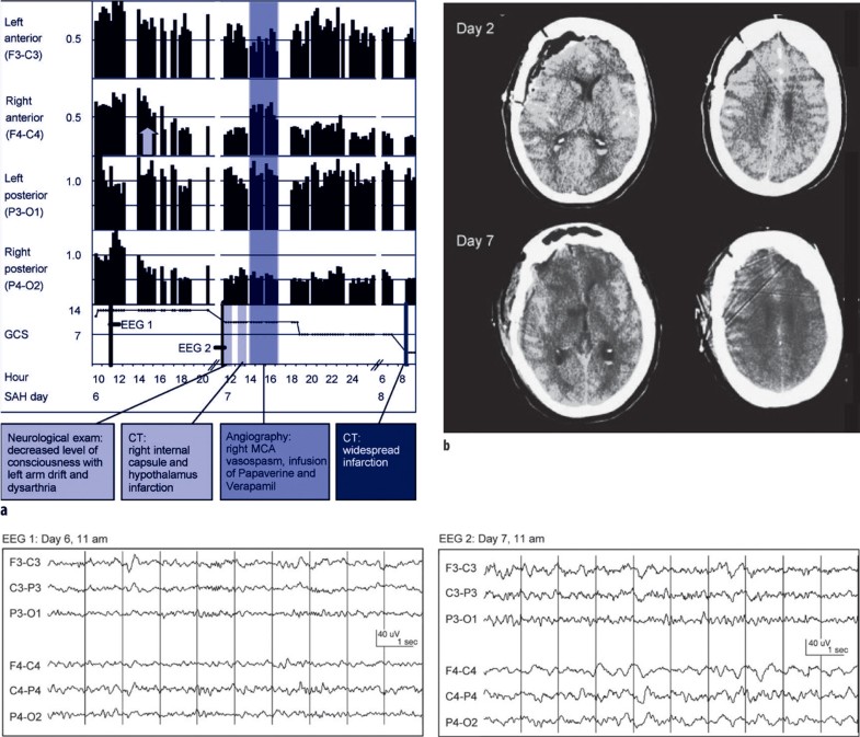 Quantitative EEG for the detection of brain ischemia | Critical Care ...