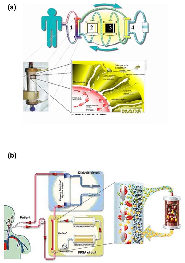 Effect of the molecular adsorbent recirculating system and Prometheus