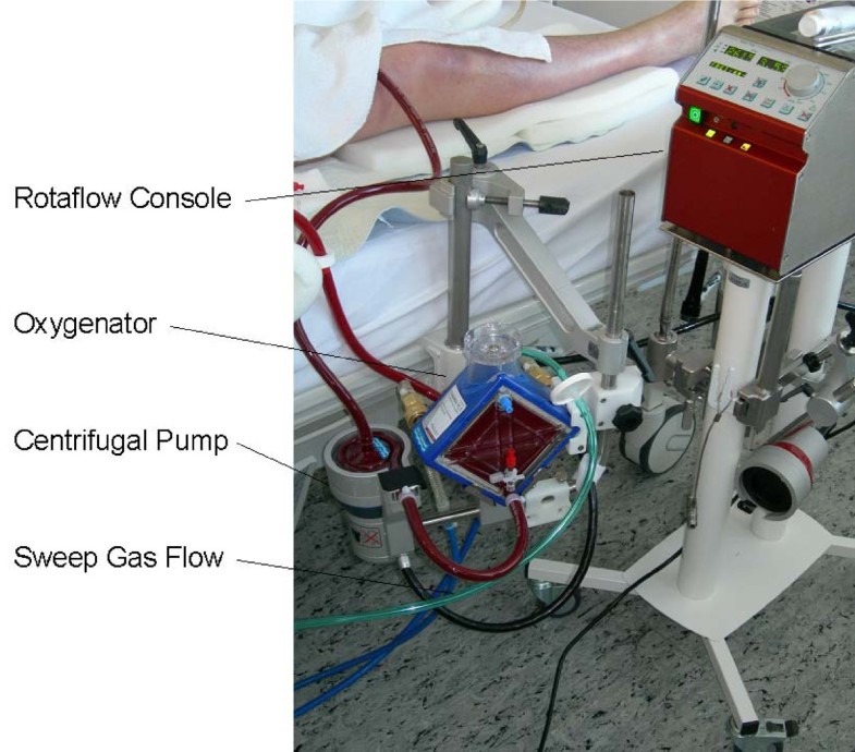 A new miniaturized system for extracorporeal membrane oxygenation in
