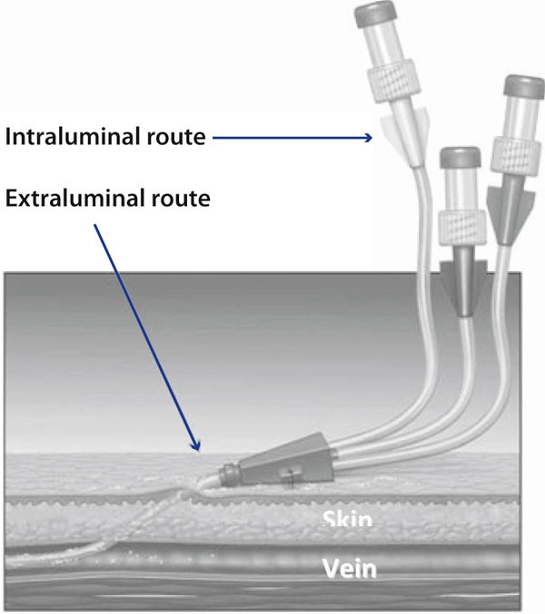 Prevention of central venous catheterrelated infection in the