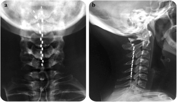Safety and efficacy of cervical 10 kHz spinal cord stimulation in