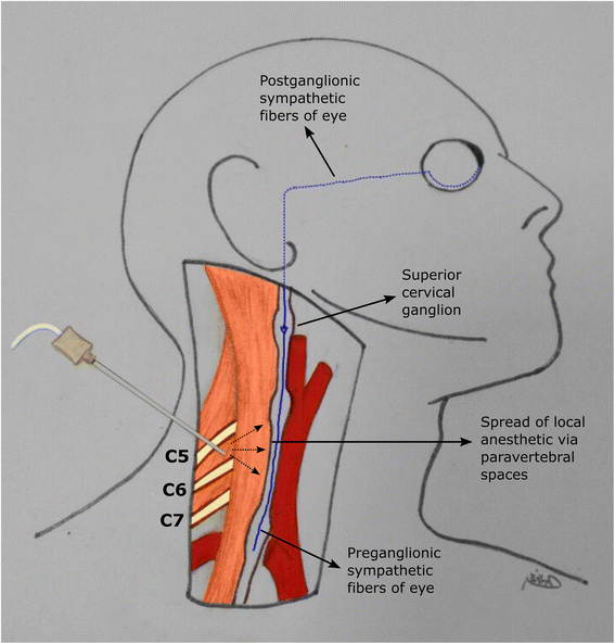 Effect of interscalene block on intraocular pressure and ocular perfusion pressure BMC