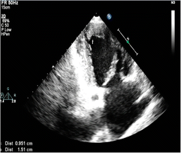 Left ventricular mural thrombus and dual coronary embolization associated with hyperthyroid ...