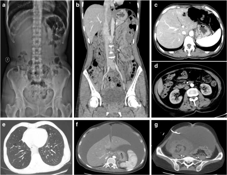 Pneumatosis cystoides intestinalis six case reports and a review of