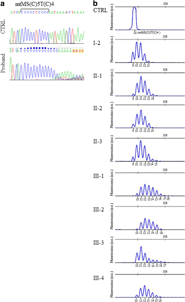 Leber’s hereditary optic neuropathy, intellectual disability and