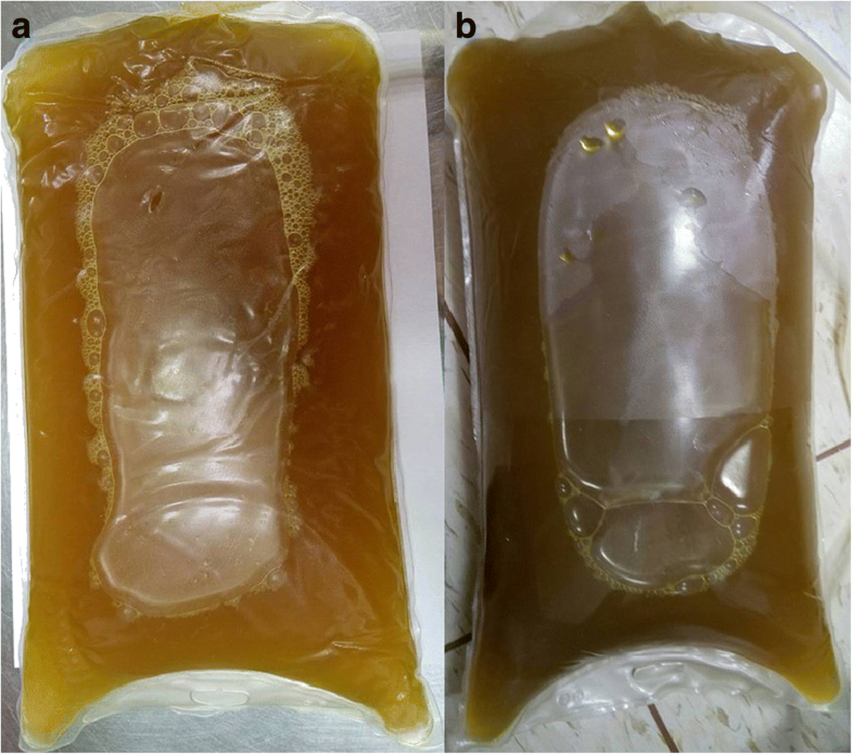 Green dialysate and gallbladder perforation in a peritoneal dialysis