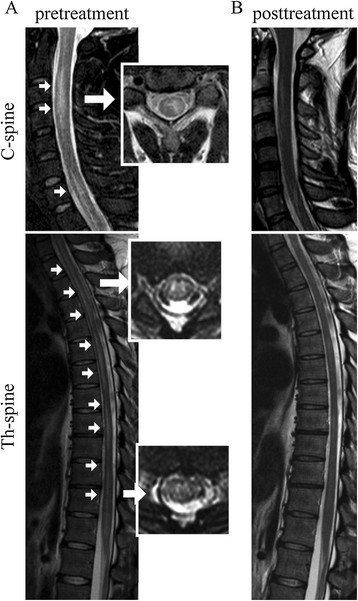 anti mog myelitis