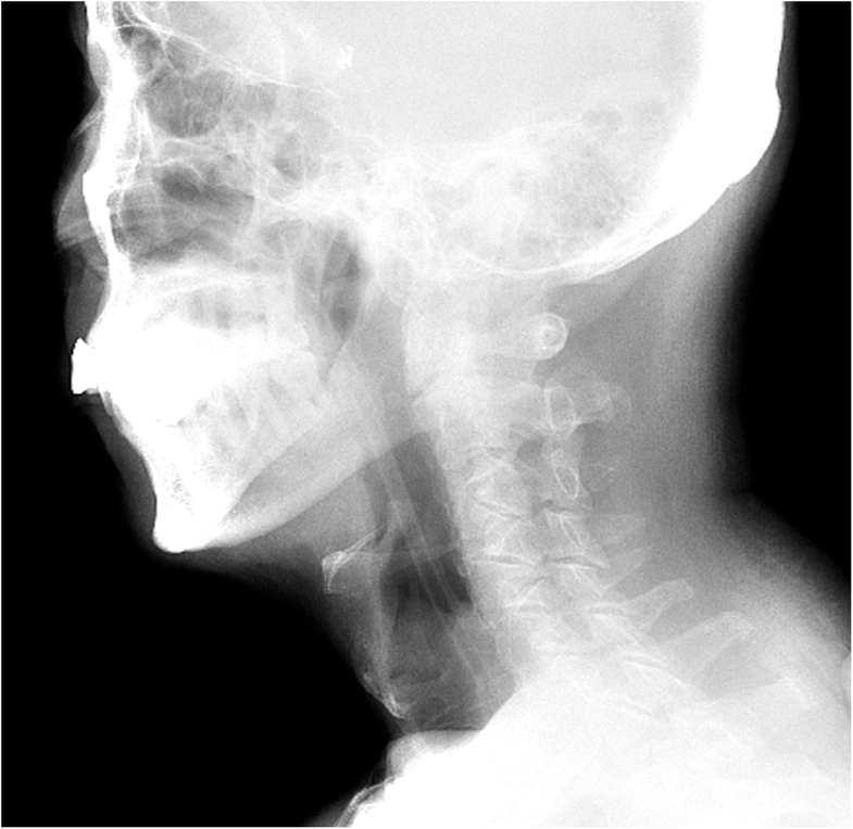 Effect of an indwelling nasogastric tube on swallowing function in elderly poststroke dysphagia