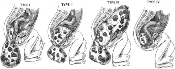 Evaluation of pregnancy and delivery in 13 women who underwent
