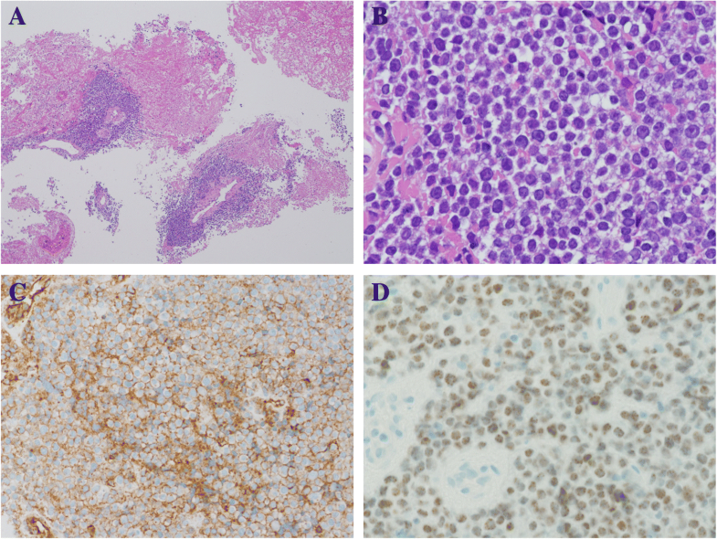 NUT carcinoma of the nasal cavity that responded to a chemotherapy