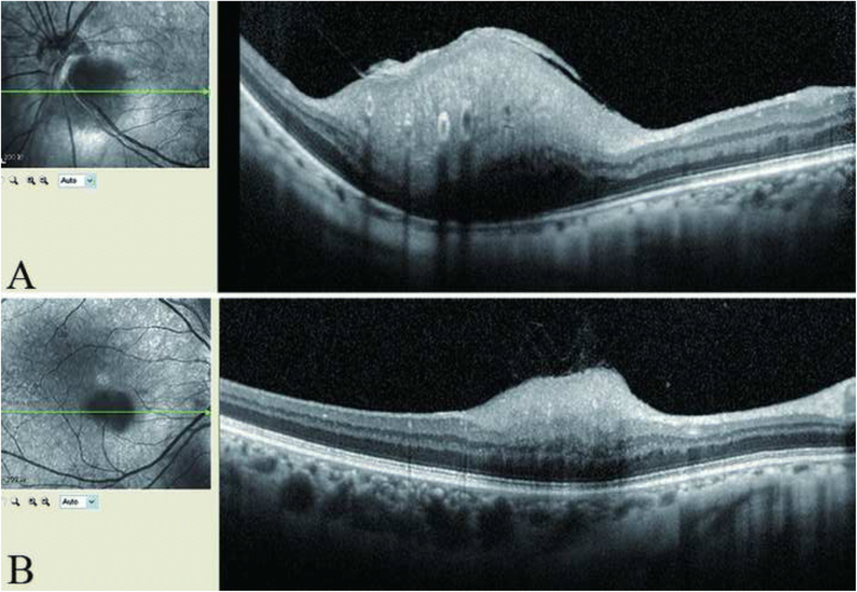 Retinal astrocytic hamartoma in tuberous sclerosis complex in an