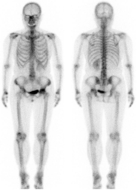 Metastasis of differentiated thyroid cancer in the subchondral bone of ...