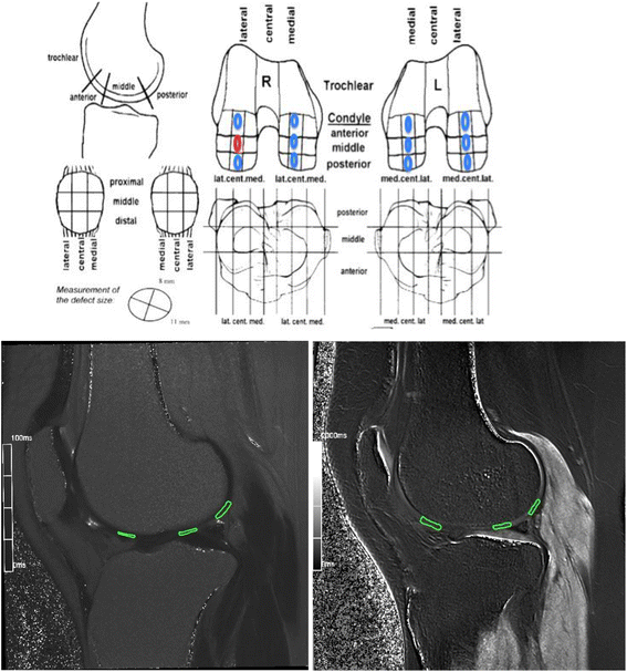 Evaluation of focal cartilage lesions of the knee using MRI T2 mapping ...