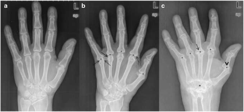 Metacarpal bone loss in patients with rheumatoid arthritis estimated by