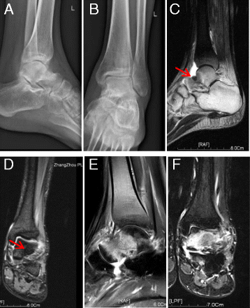 A misdiagnosed case of osteoid osteoma of the talus: a case report and ...