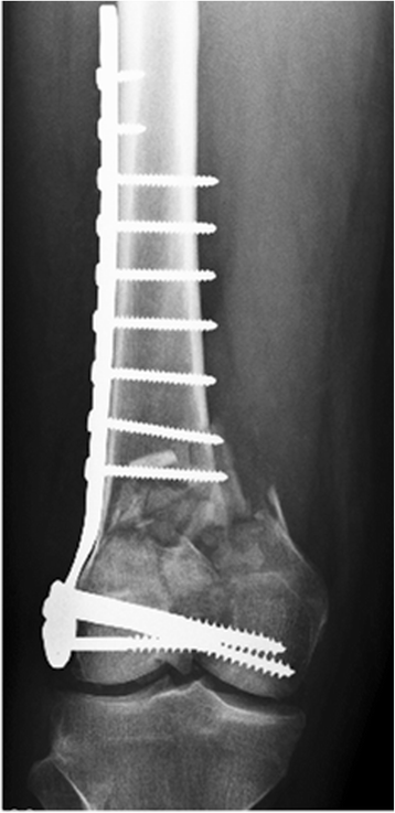 Subcutaneous emphysema of the leg after hardware removal and bone