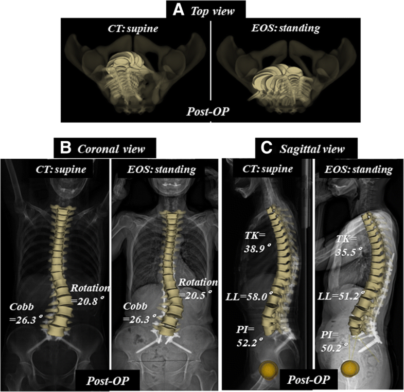 Difference in whole spinal alignment between supine and standing