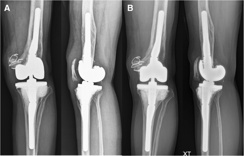 Antibioticimpregnated articulating cement spacer maintained for 7