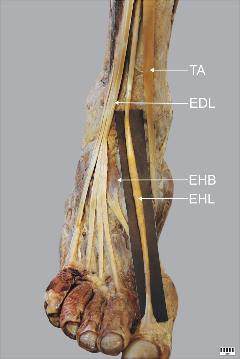 A cadaveric study of the morphology of the extensor hallucis longus - a