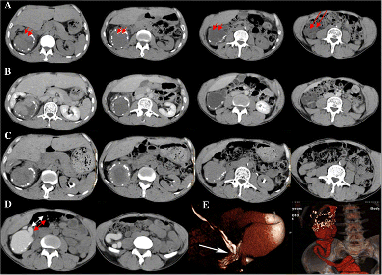 Prolonged CT urography in duplex kidney BMC Urology Full Text
