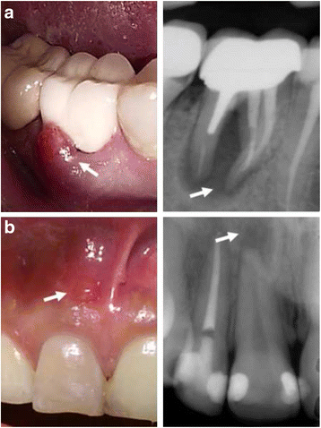 Single-visit endodontic treatment of mature teeth with 