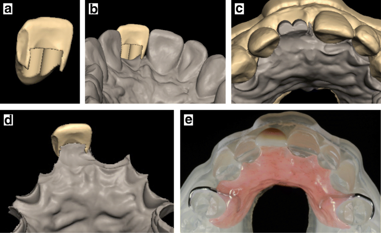 Manufacturing of an immediate removable partial denture with an ...
