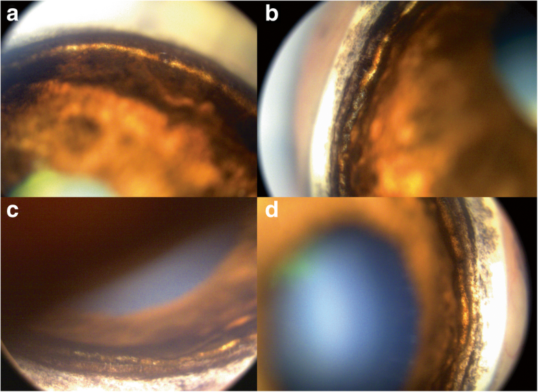 Primary angleclosure with goniodysgenesis in a Beagle dog