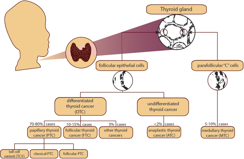 Thyroid cancers of follicular origin in a genomic light ...
