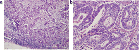 Small bowel adenocarcinoma of the jejunum: a case report and literature ...