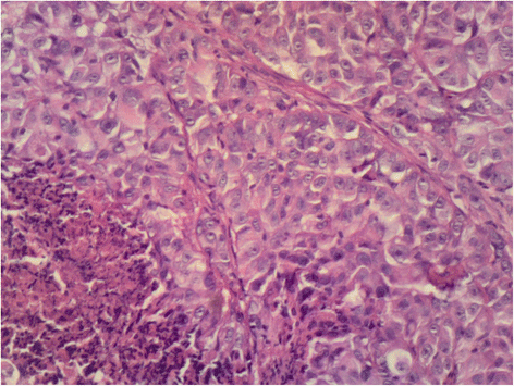 A case report of metastasis of malignant mesothelioma to ...