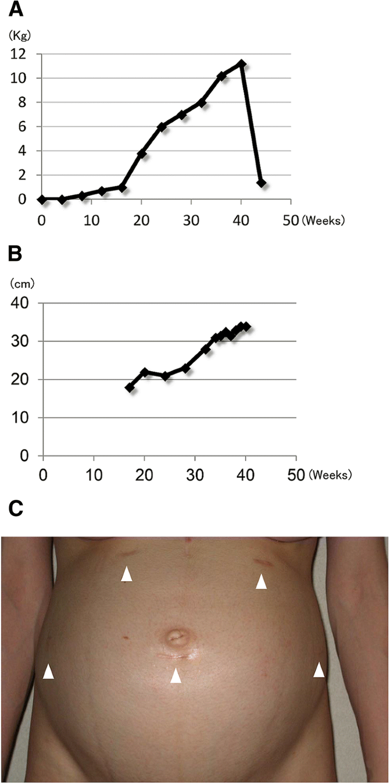 Pregnancy, delivery, and breastfeeding after total gastrectomy for