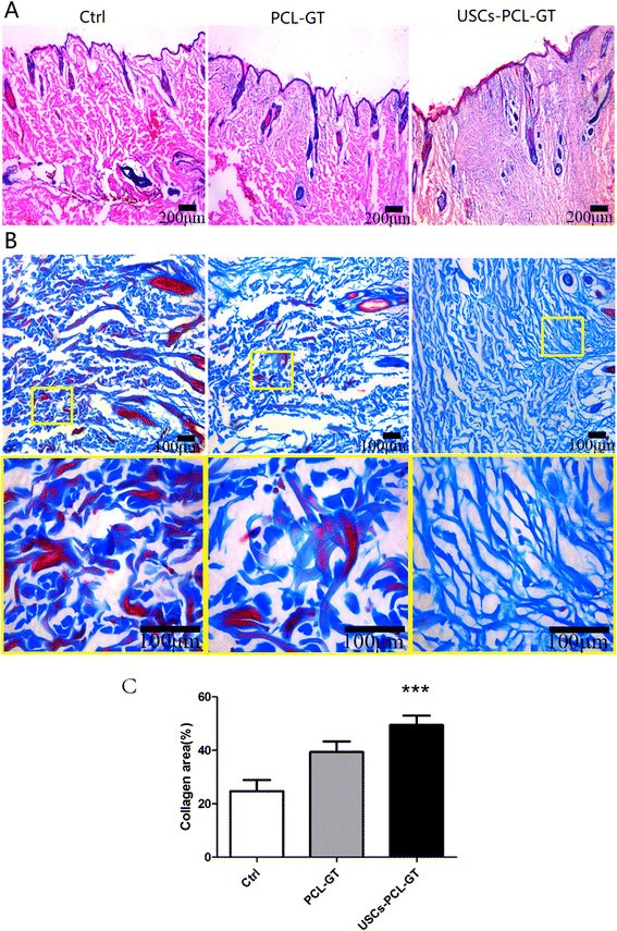 Human urinederived stem cells in combination with polycaprolactone