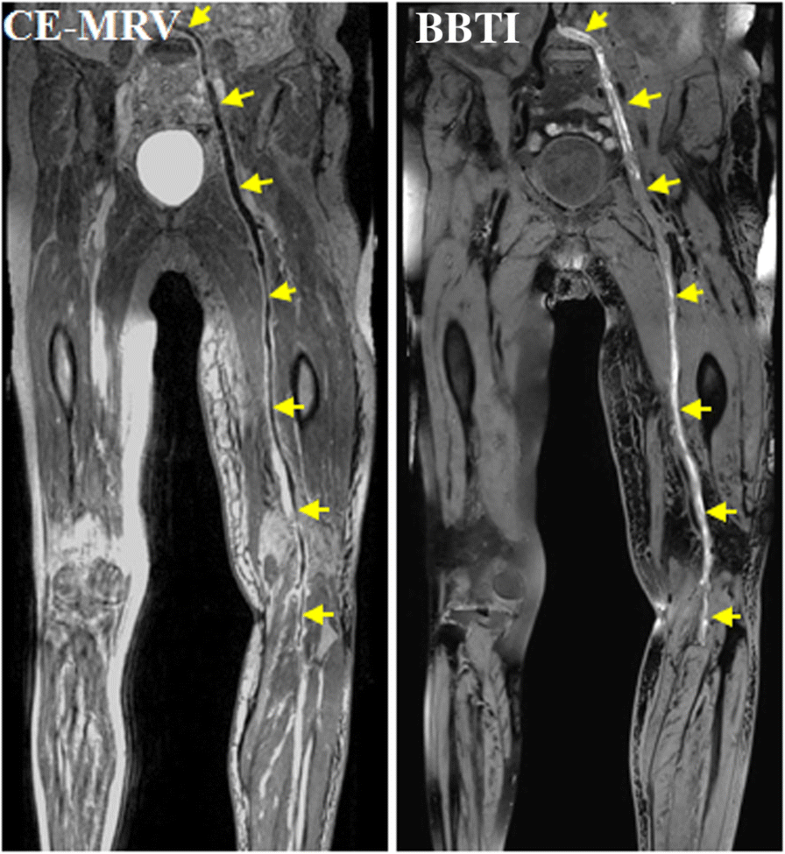 Cardiovascular resonance blackblood thrombus imaging for the